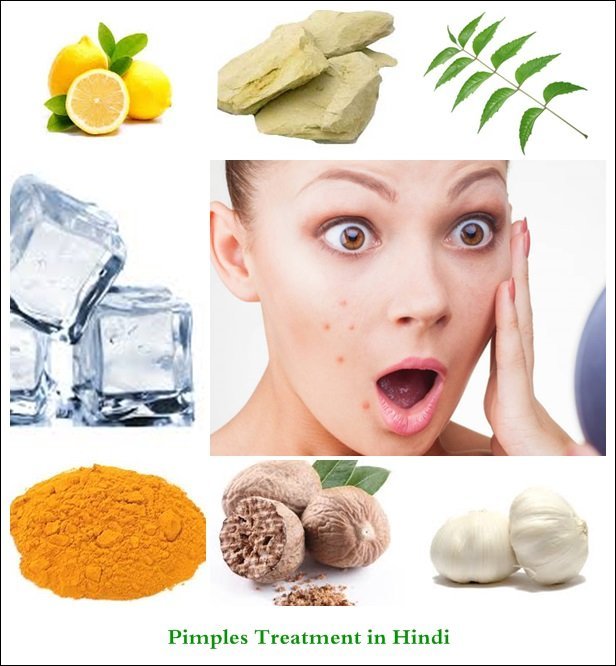 Pimples Treatment and Solution Tips in Hindi - Gharelu Nuskhe (Home  remedies) aur Ilaj ke Upay | Hindi Lookup | Tips in Hindi